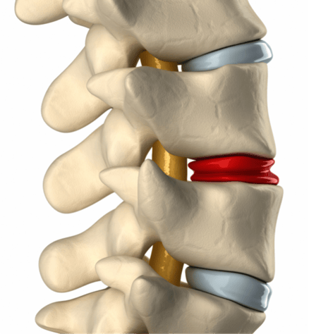 Spinal-stenosis-img1