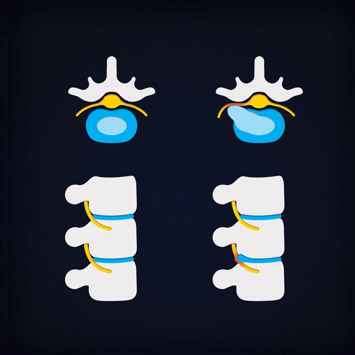 Sitting Smart The Best Office Chair for Disc Herniation