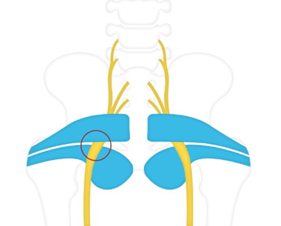 sciatica-genetic-img1