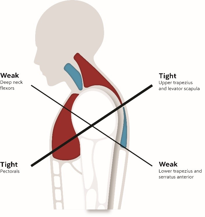 Poor Posture: The Main Culprit Behind Muscle Tension