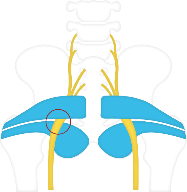 HOW TO TREAT PIRIFORMIS SYNDROME: THE ROLE OF THE SEAT CUSHION - Fine Foams